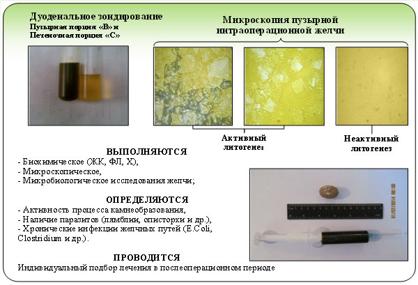 Индивидуальный подход к выбору метода лечения желчнокаменной болезни