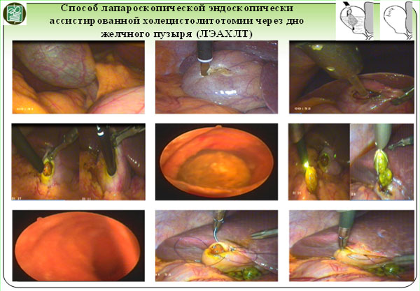 Способ лапароскопического эндоскопически ассистированного удаления конкремента через дно желчного пузыря
