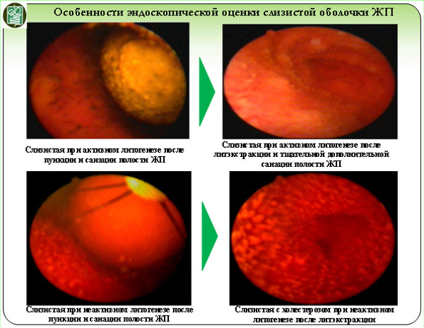 Особенности эндоскопической оценки слизистой оболочки ЖП