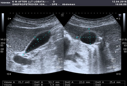УЗИ желчного пузыря после выполнения операции
