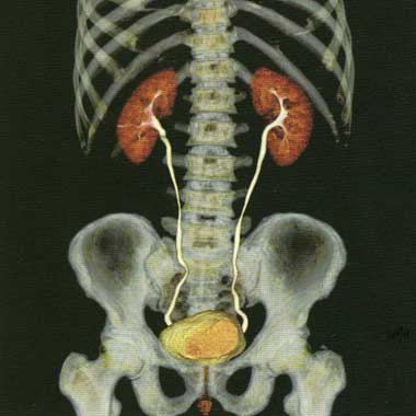 Томография мочевыделительной системы