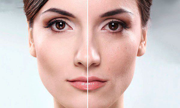 Мезотерапия