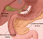 Панкреатит - аспекты хирургического лечения