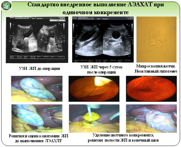 Стандартно внедренное выполнение лапароскопической эндоскопически ассистированной холецистолитотомии