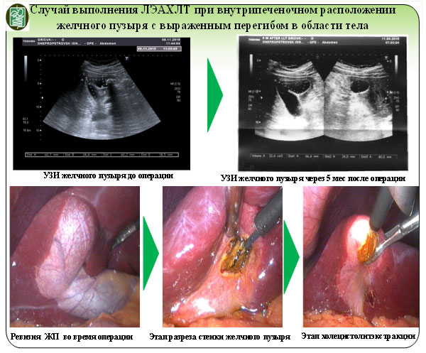 При УЗИ желчный пузырь неправильной формы с Г-образным перегибом в области тела, расположен внутрипеченочно