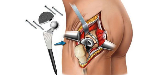 Эндопротезирование тазобедренного сустава: показания, ход операции, стоимость