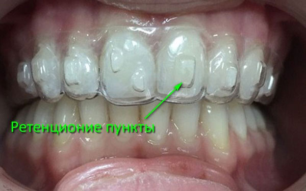 Действительно ли прозрачные элайнеры работают?