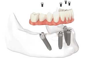 Имплантация All on 4 - все на 4 имплантах