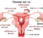 Лікування маткової міоми