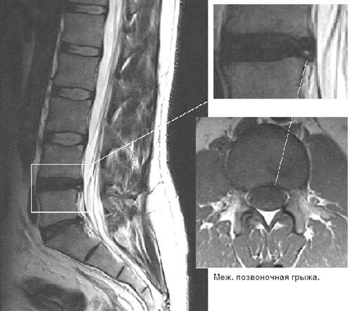 Грыжа межпозвонкового диска