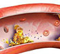 Атеросклероз та його лікування