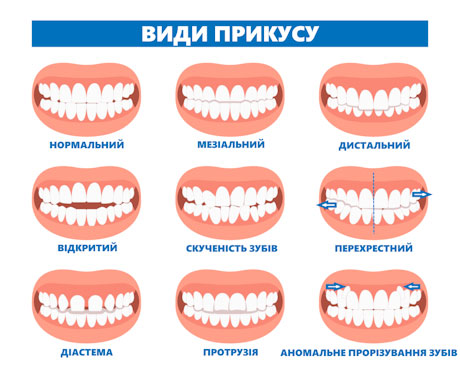 Методи виправлення прикусу