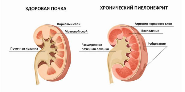 Различия между острой и хронической формами