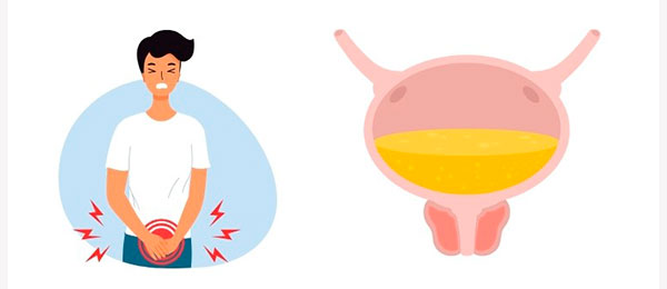 Доброякісна гіперплазія передміхурової залози - симптоми та діагностика