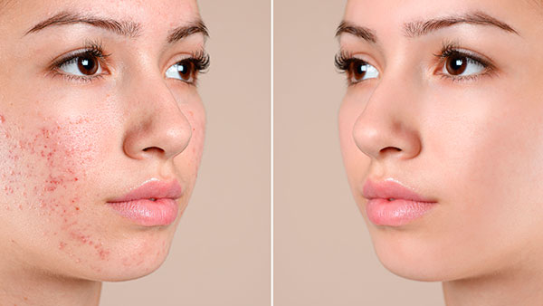 Проблемна юнацька та жирна шкіра