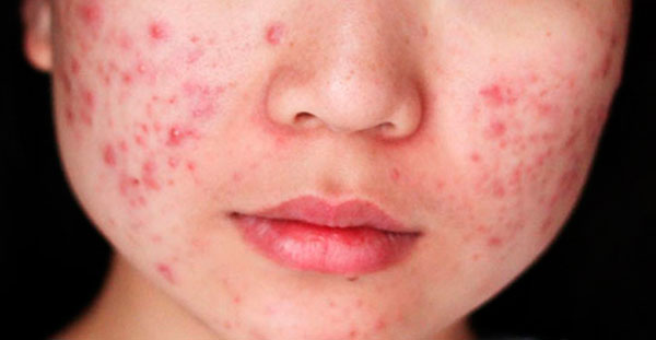 Поширені дерматологічні проблеми у Дніпрі Поширені дерматологічні проблеми у Дніпрі