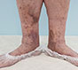 Что означают коричневые пятна на ногах у взрослых?