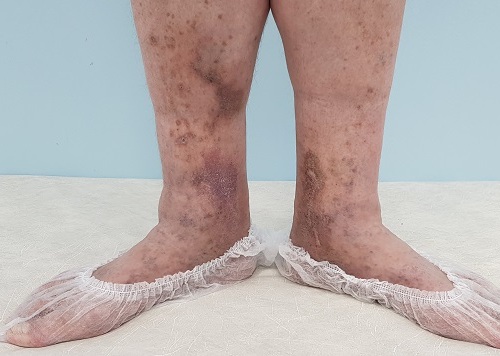 Что означают коричневые пятна на ногах у взрослых?