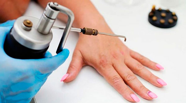 Лікарі-дерматологи рекомендують кріодеструкцію