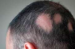 Очаговая алопеция: роль иммунитета и аутоиммунные механизмы