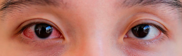 Симптоми офтальмологічних захворювань