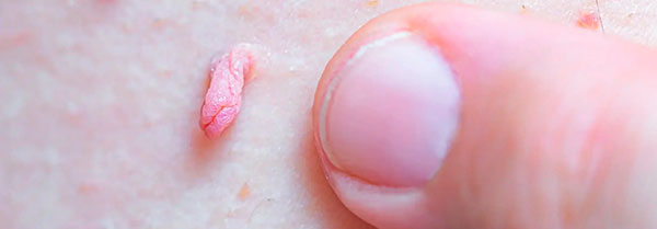 Вірус папіломи людини Вірус папіломи людини