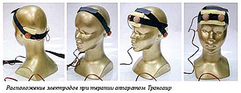 ТРАНСКРАНИАЛЬНАЯ ИМПУЛЬСНАЯ БИПОЛЯРНАЯ ЭЛЕКТРОСТИМУЛЯЦИЯ ГОЛОВНОГО МОЗГА